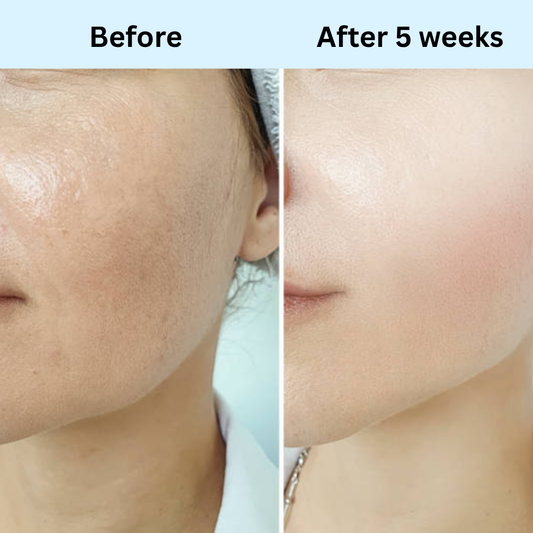 Skin Radio Frequency Device