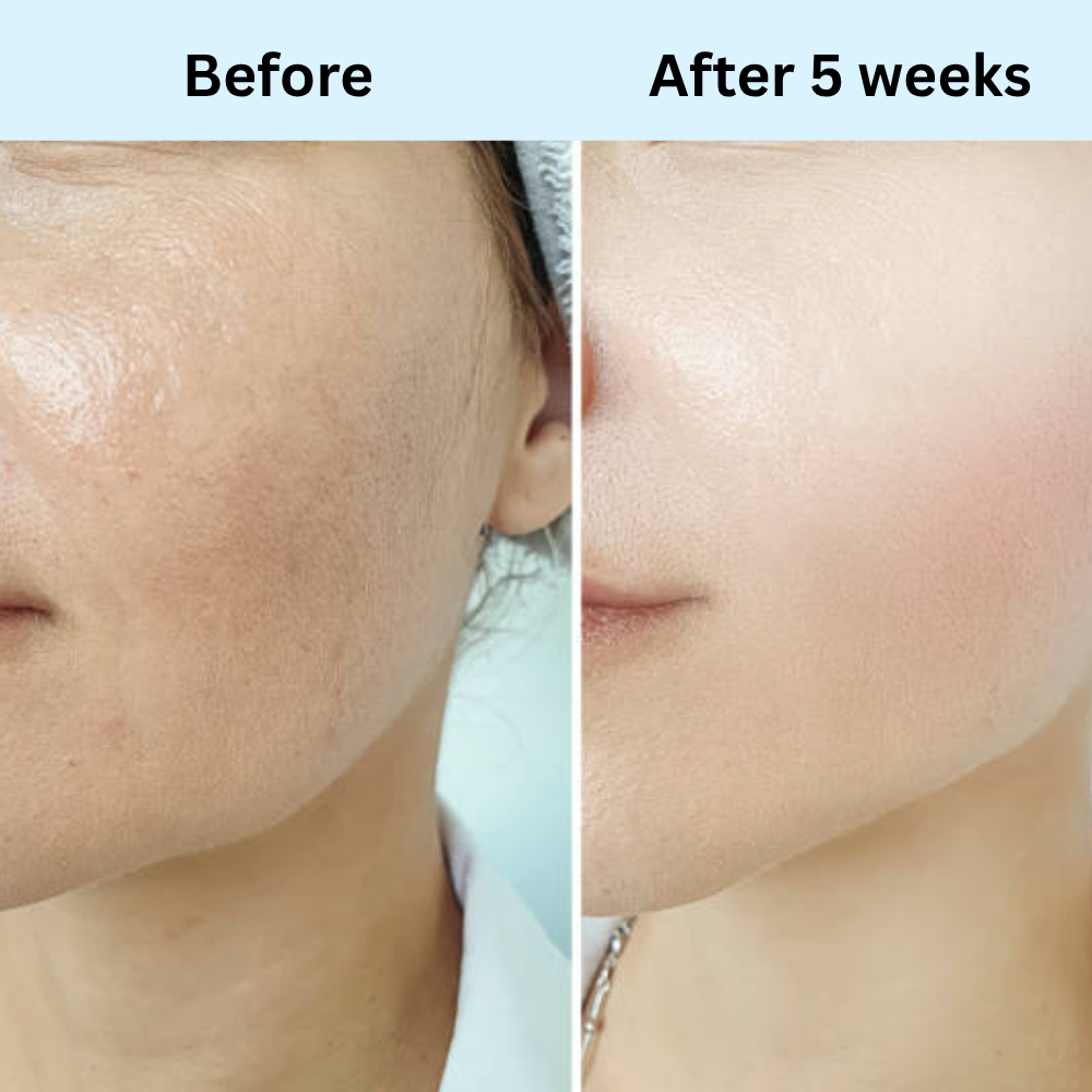 Skin Radio Frequency Device